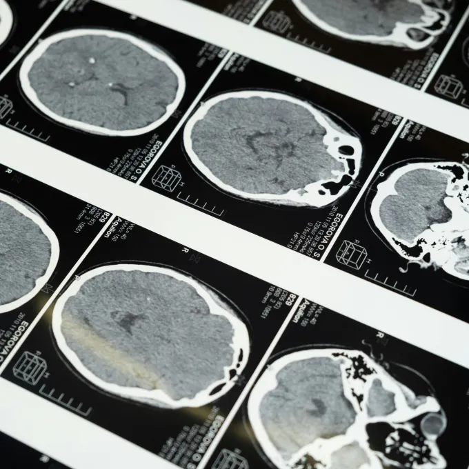 brain MRI
