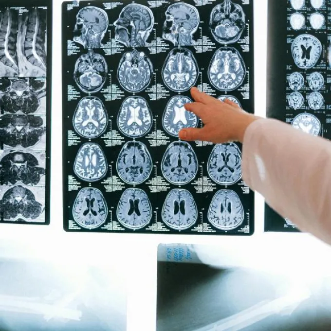 Photo of brain MRIs